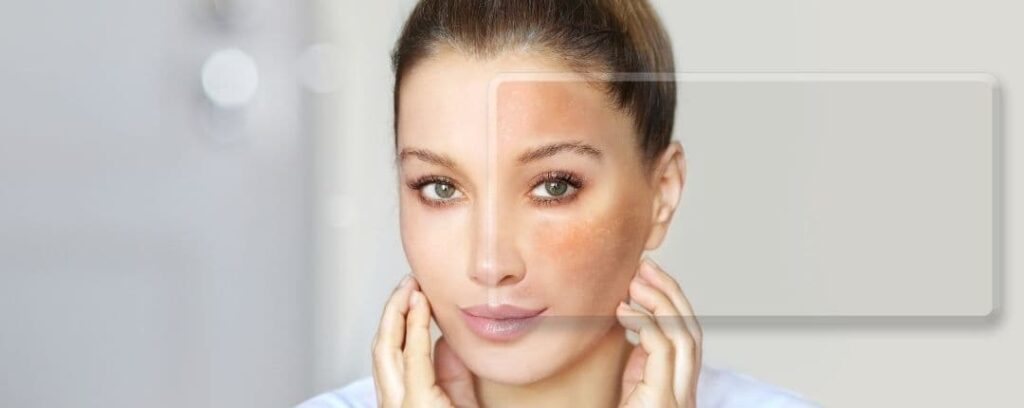 Cómo eliminar el melasma