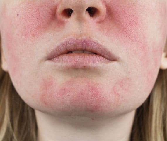 que es la rosacea Qué es la rosácea