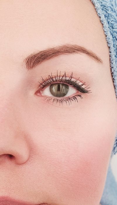 Tratamiento para las ojeras con ácido hialurónico