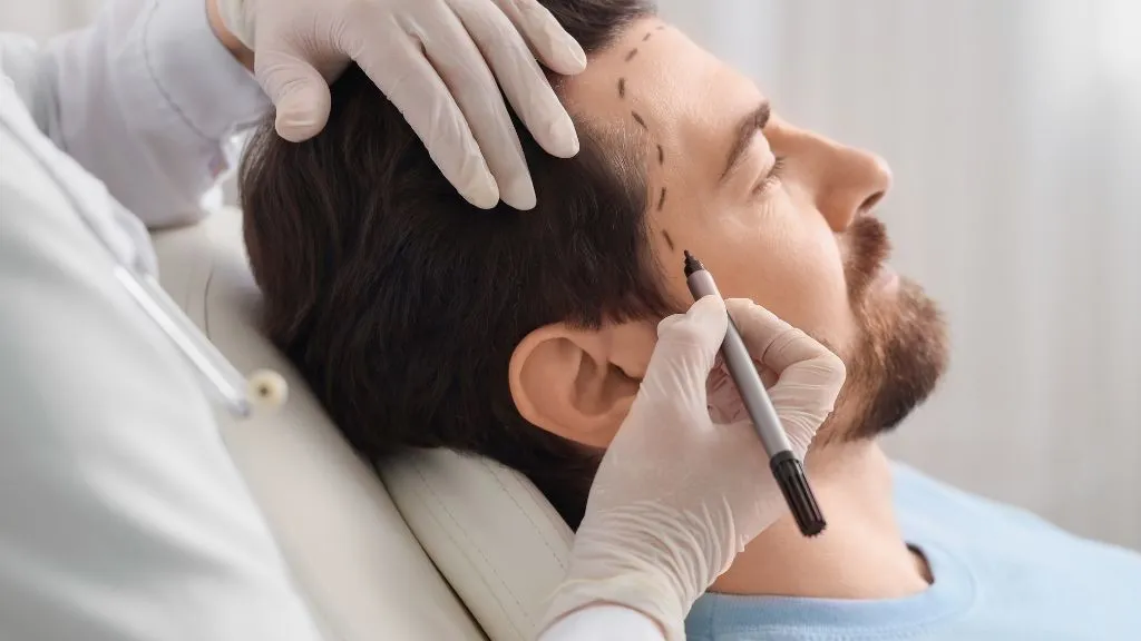 Marcación mandibular en hombre con marcaje previo antes de aplicar ácido hialurónico para definir el jawline