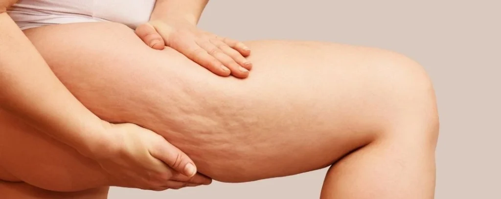 Primer plano de un muslo con celulitis estética o piel de naranja.