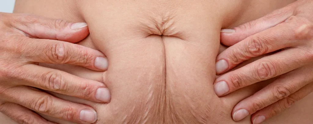Flacidez en la piel del abdomen con estrías tras cambios de peso